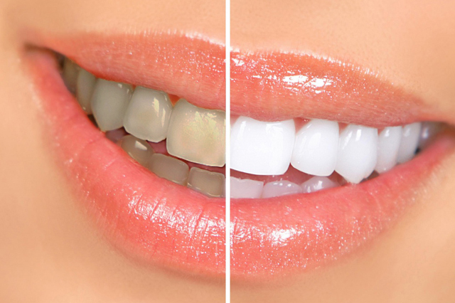 Teeth Whitening 1